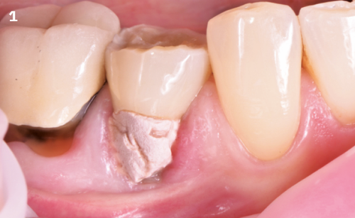 1 | Initial situation: the tooth has been treated endodontically without success.