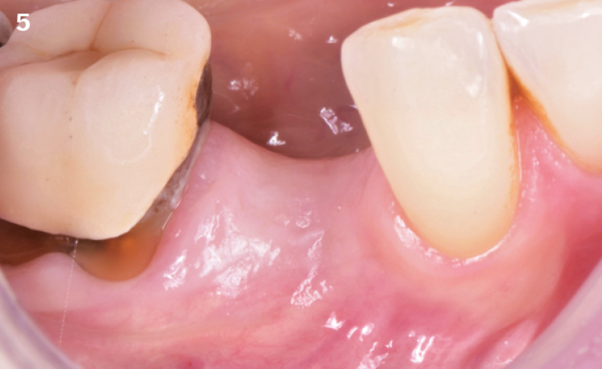 5 | After 5 months, the situation is stable and the keratinized tissue is restored.
