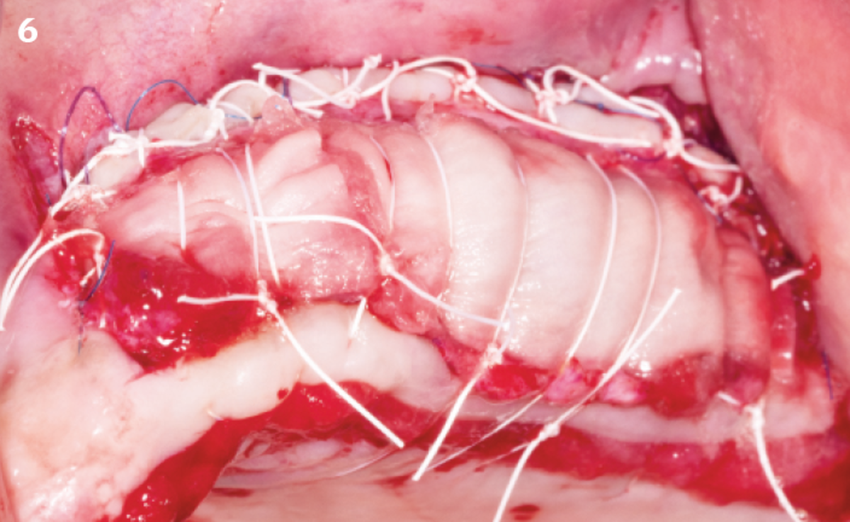 6 | Geistlich Mucograft® is stabilized onto the site. Sutures and surgical area are then covered with REGENFAST®.