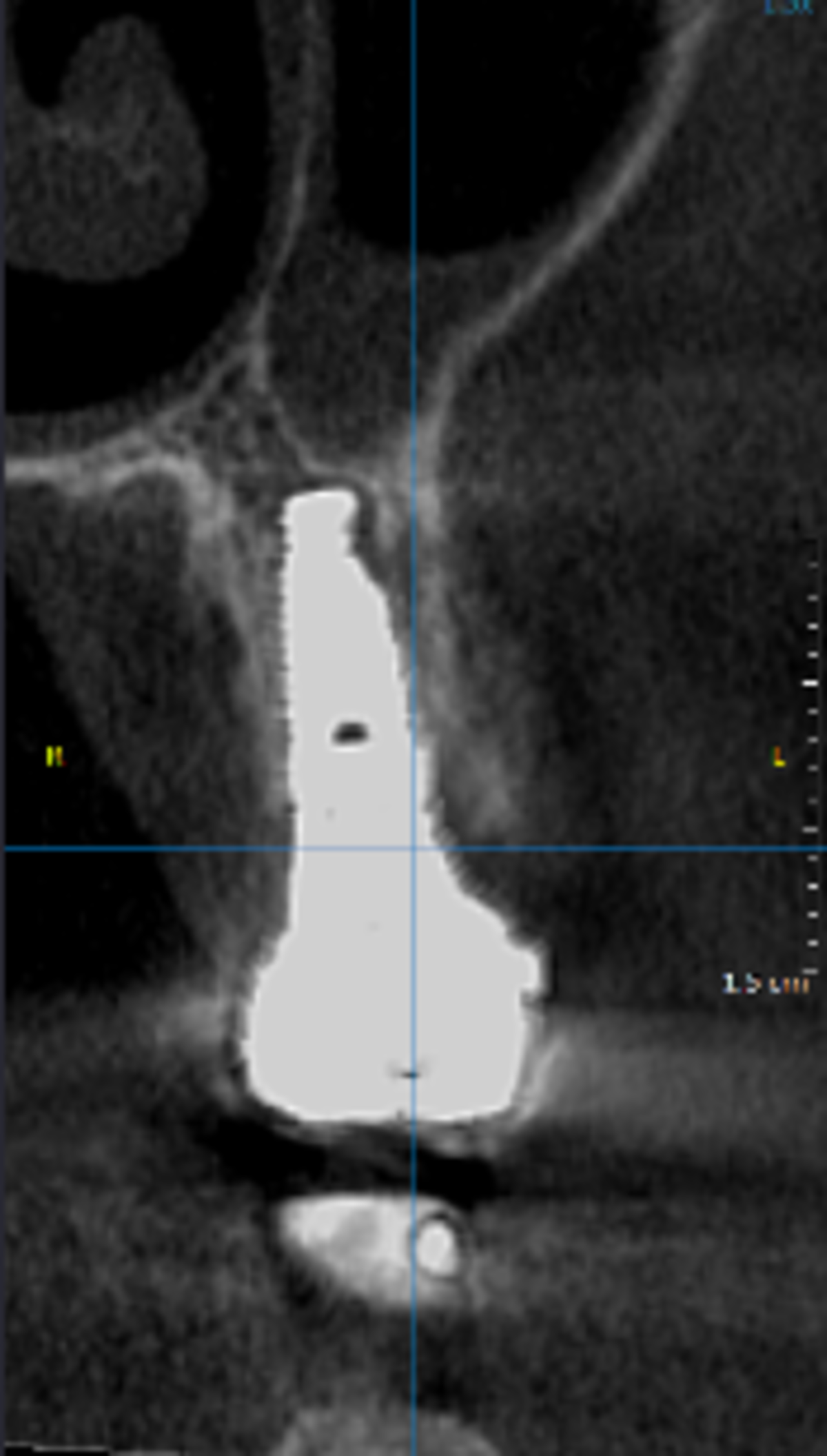 Tomografia Computorizada de Feixe Cónico (TCFC) em 1 ano