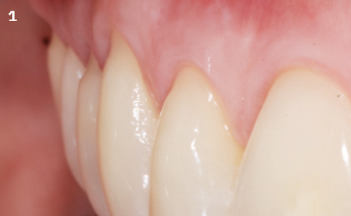 1 | Pre-operative situation: Miller class I multiple gingival recession on teeth 11 to 14, 1-2 mm depth. Sufficient keratinized tissue height.
