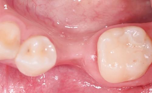 1 | The presence of severe horizontal atrophy in the edentulous site is clinically visible.