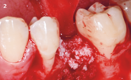 2 | After flap elevation, Geistlich Bio-Oss® is
mixed with REGENFAST® and positioned at the level of the defect for the reconstruction of the alveolar crest.