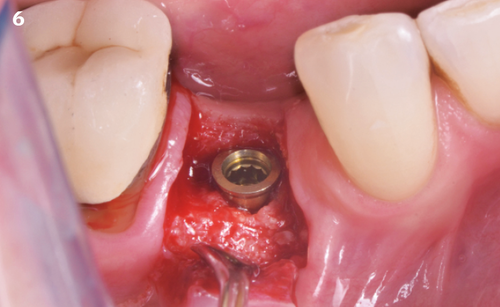 6 | An intermediate abutment is placed at the time of implant insertion.