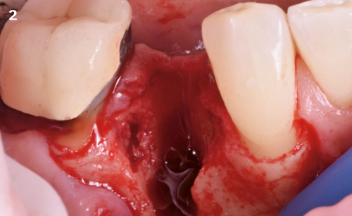 2 | The buccal bone is not intact.