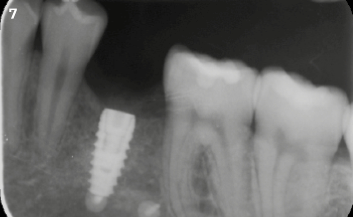 7 | Radiographic image after 3 months at the time of reopening.