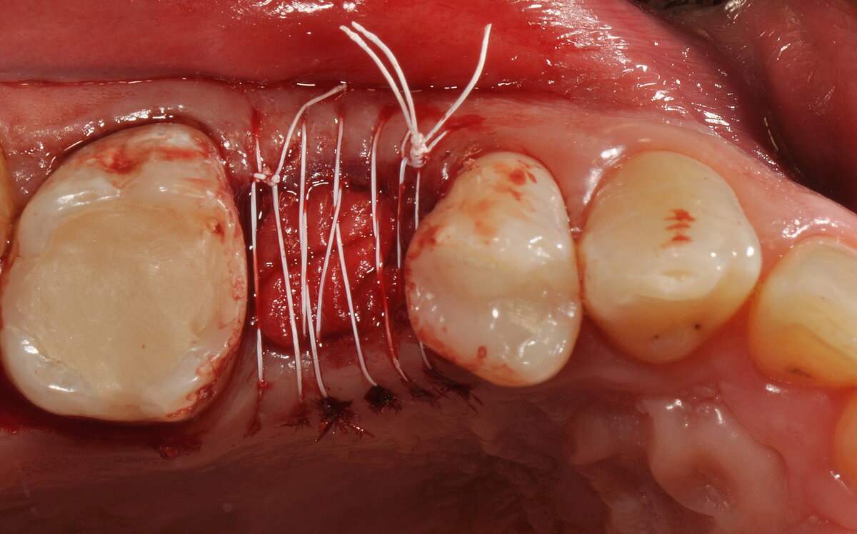 revestida com membrana de colágeno Geistlich Bio-Gide® estabilizada por sutura contínua de PTFE.