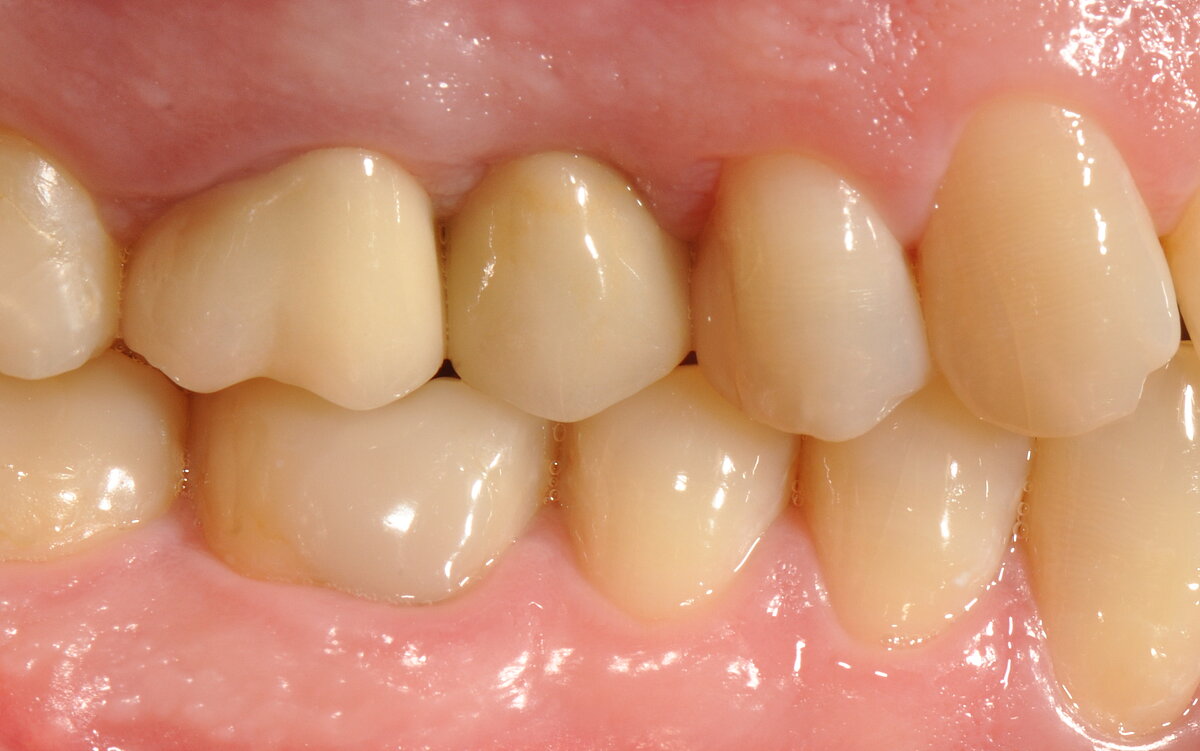 Healthy soft-tissue and esthetic outcome 1 year post surgery.