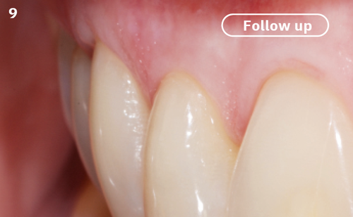 9 | At 6 months post-operatively, the gingival thickness obtained shows more resistance to tooth brushing.