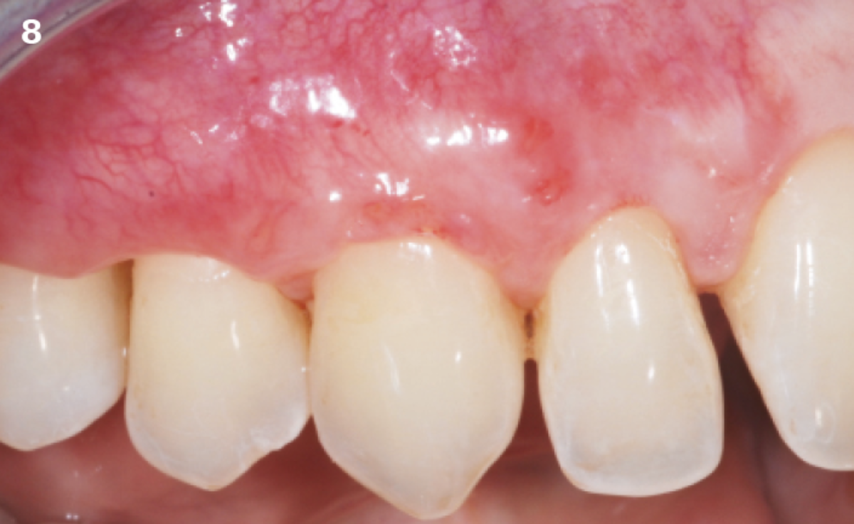 8 | At 15 days post-operatively, a complete root coverage was obtained for all the treated recessions. The esthetic integration is already satisfactory.