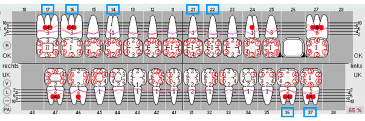 Before treatment (pockets treated with Pocket-X® Gel are labeled in blue)